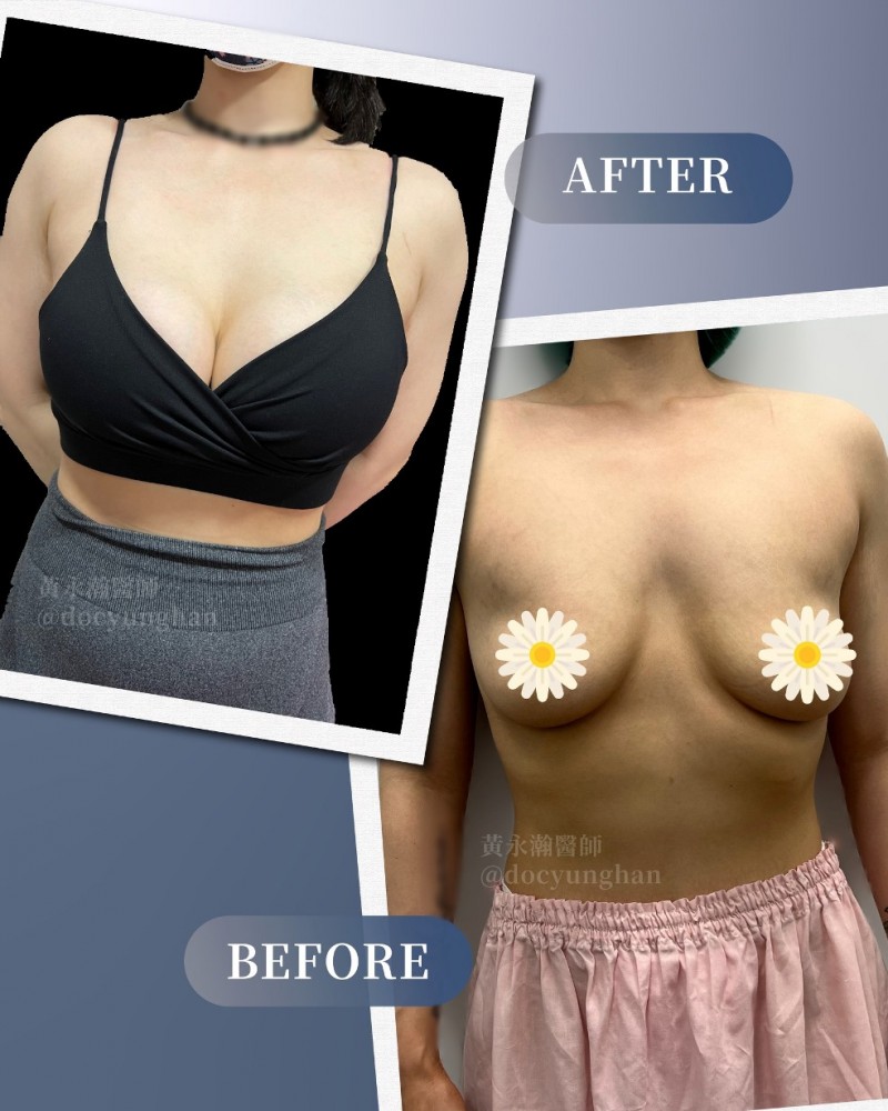 隆乳假體手術,隆乳案例,隆乳,黃永瀚醫生,博恩妍
